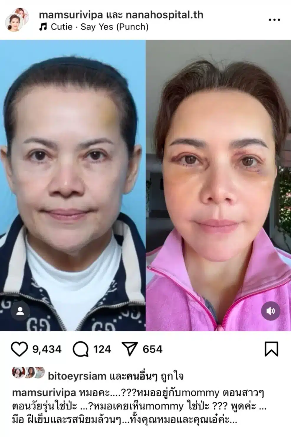 หนูแหม่ม สุริวิภา หน้าก่อนหลังทำศัลยกรรม 14 วัน