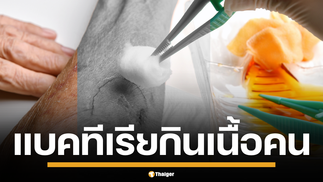 แบคทีเรียกินเนื้อคน คืออะไร ติดจาก ดิน-น้ำ-ทะเล เข้าแผลลามถึงตาย แนะวิธีป้องกัน สังเกตอาการด่วนคนไทยกลุ่มไหนเสี่ยงบ้าง