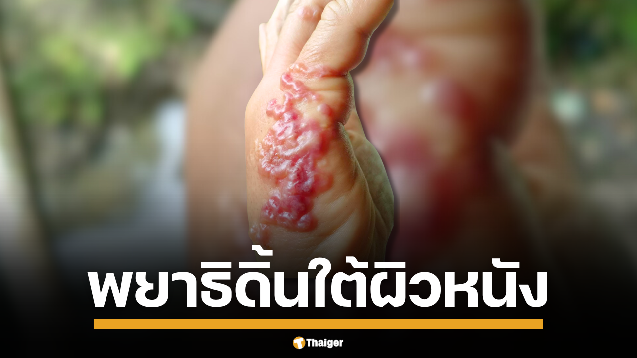 เตือนภัยคนรักสัตว์-สายลุยสวน! ระวังพยาธิหมาแมวไชผิว ก่อผื่นแดงเคลื่อนที่สุดทรมาน รู้ทันโรคตัวอ่อนพยาธิไชผิวหนังและวิธีป้องกันที่นี่