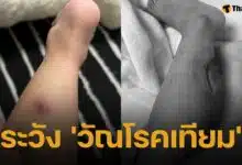แม่เตือนอันตราย "วัณโรคเทียม" ทำลูก 2 ขวบ "ถูกตัดเนื้อทิ้ง" โรคร้ายที่หลายคนไม่รู้จัก