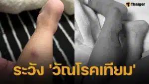 แม่เตือนอันตราย "วัณโรคเทียม" ทำลูก 2 ขวบ "ถูกตัดเนื้อทิ้ง" โรคร้ายที่หลายคนไม่รู้จัก