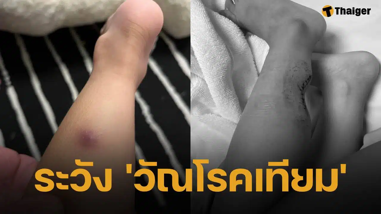 แม่เตือนอันตราย "วัณโรคเทียม" ทำลูก 2 ขวบ "ถูกตัดเนื้อทิ้ง" โรคร้ายที่หลายคนไม่รู้จัก