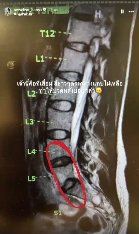 นิวเคลียร์ หรรษา เปิดสาเหตุที่ทำให้ปวดหลังบ่อย