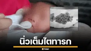 เด็กทารกมีนิ่วเต็มไต