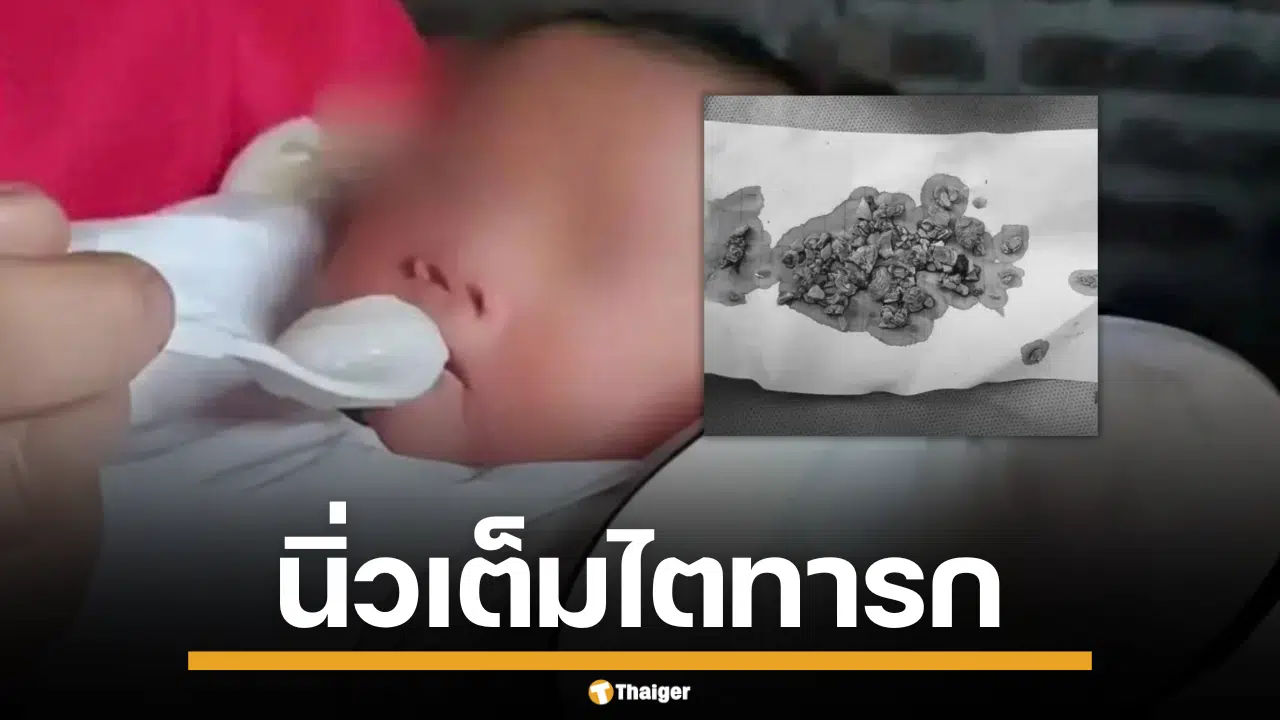 เด็กทารกมีนิ่วเต็มไต