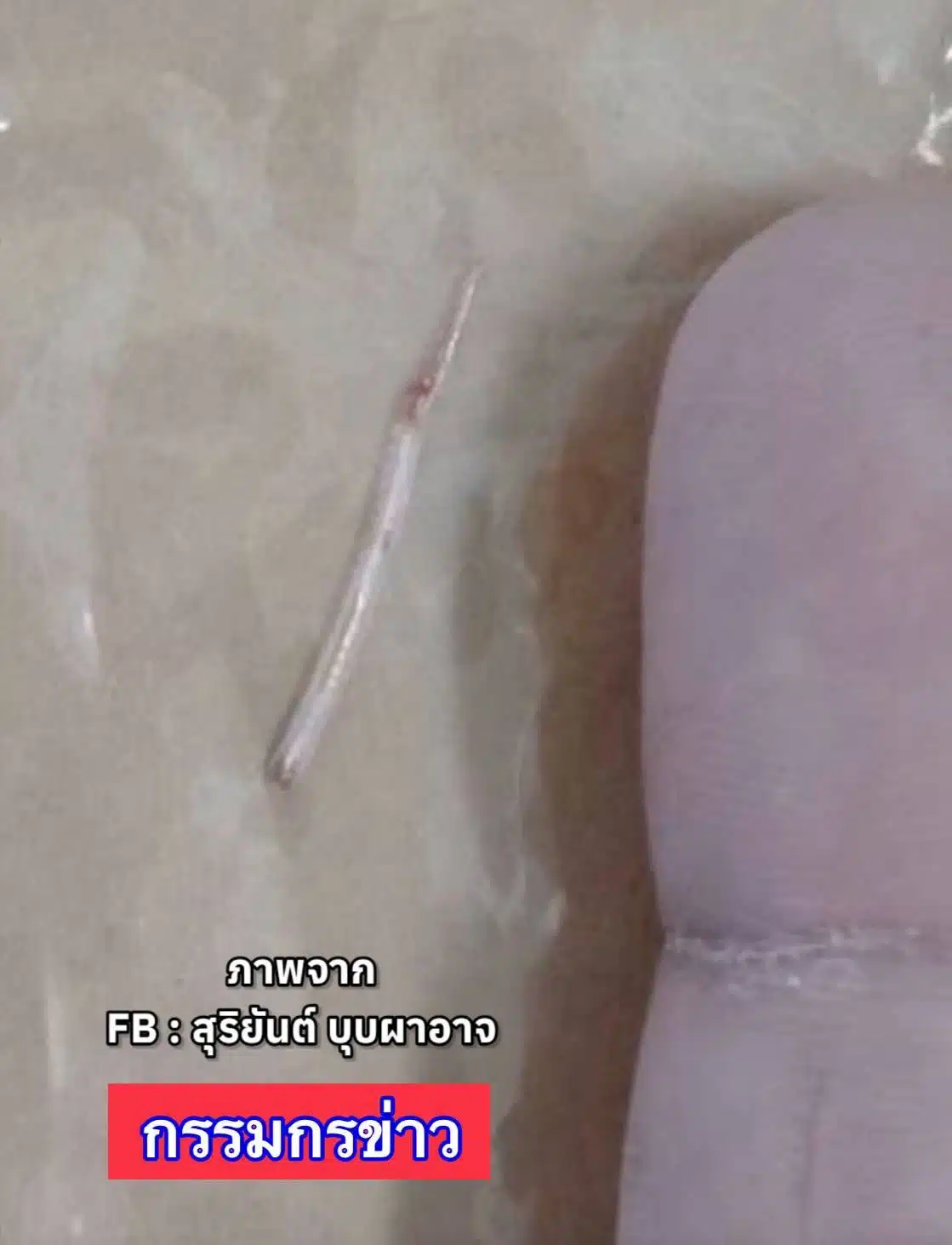 อุทาหรณ์ ก้างปลาติดคอถึง 2 อาทิตย์ จนแทงทะลุคอ หมออึ้งเพิ่งเคยเห็น
