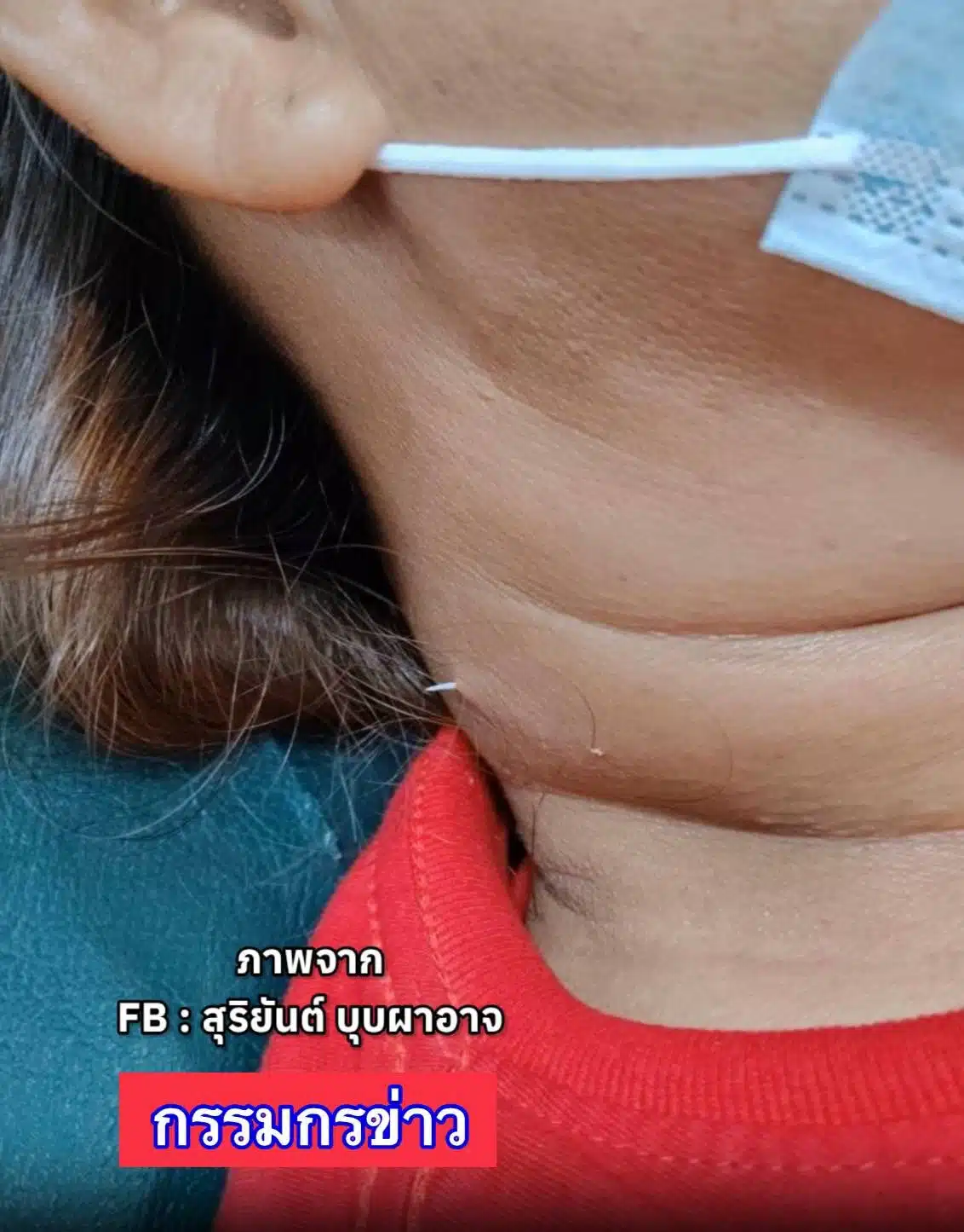 อุทาหรณ์ ก้างปลาติดคอถึง 2 อาทิตย์ จนแทงทะลุคอ หมออึ้งเพิ่งเคยเห็น