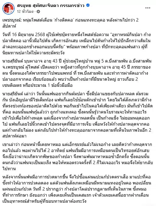อุทาหรณ์ ก้างปลาติดคอถึง 2 อาทิตย์ จนแทงทะลุคอ หมออึ้งเพิ่งเคยเห็น