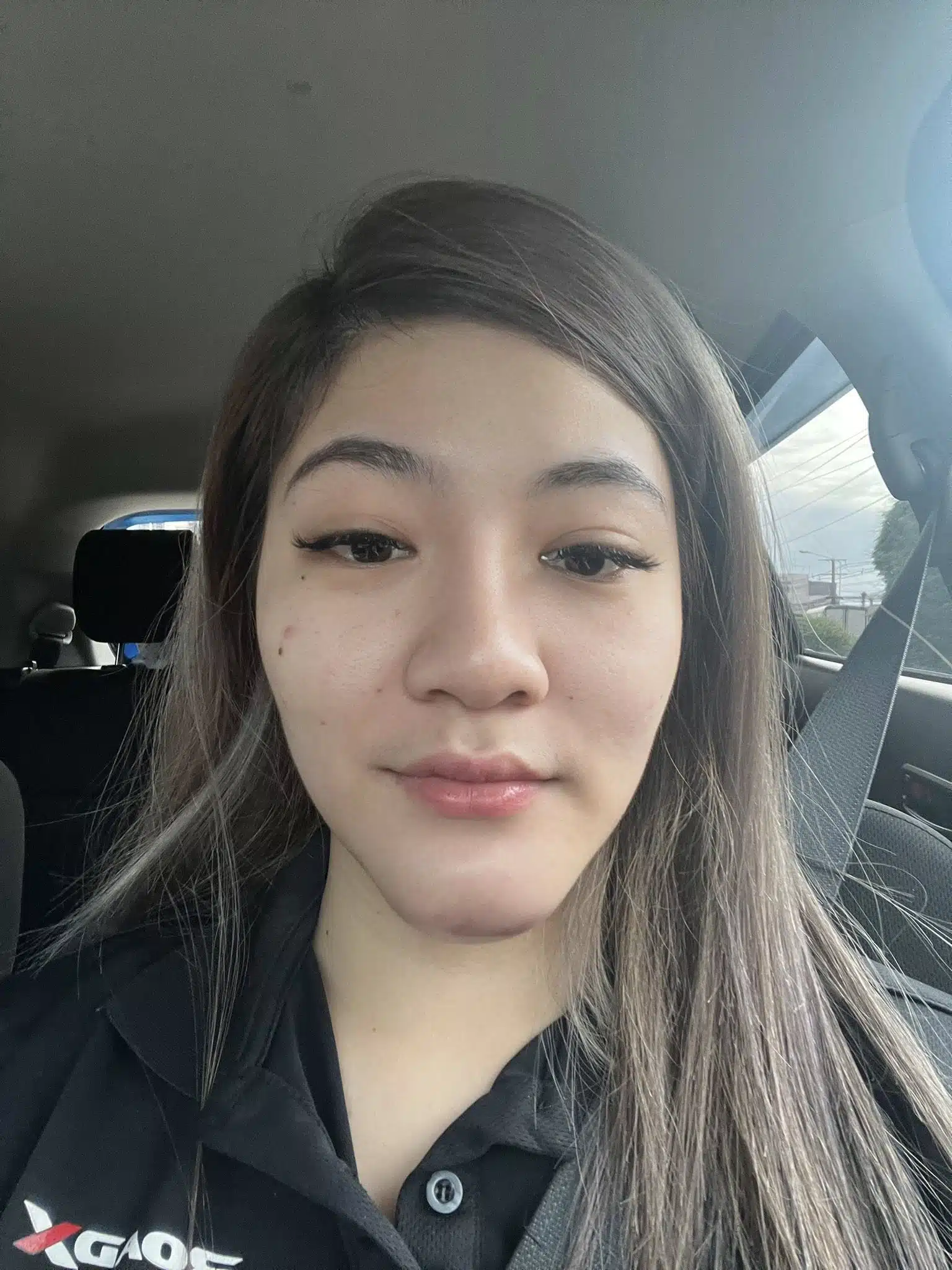 สาวแชร์ประสบการณ์ แพ้ฟิลเลอร์ เสียโฉมจนแพนิค ชาวเน็ตเห็นตรงกัน ไม่ทำก็สวย-2