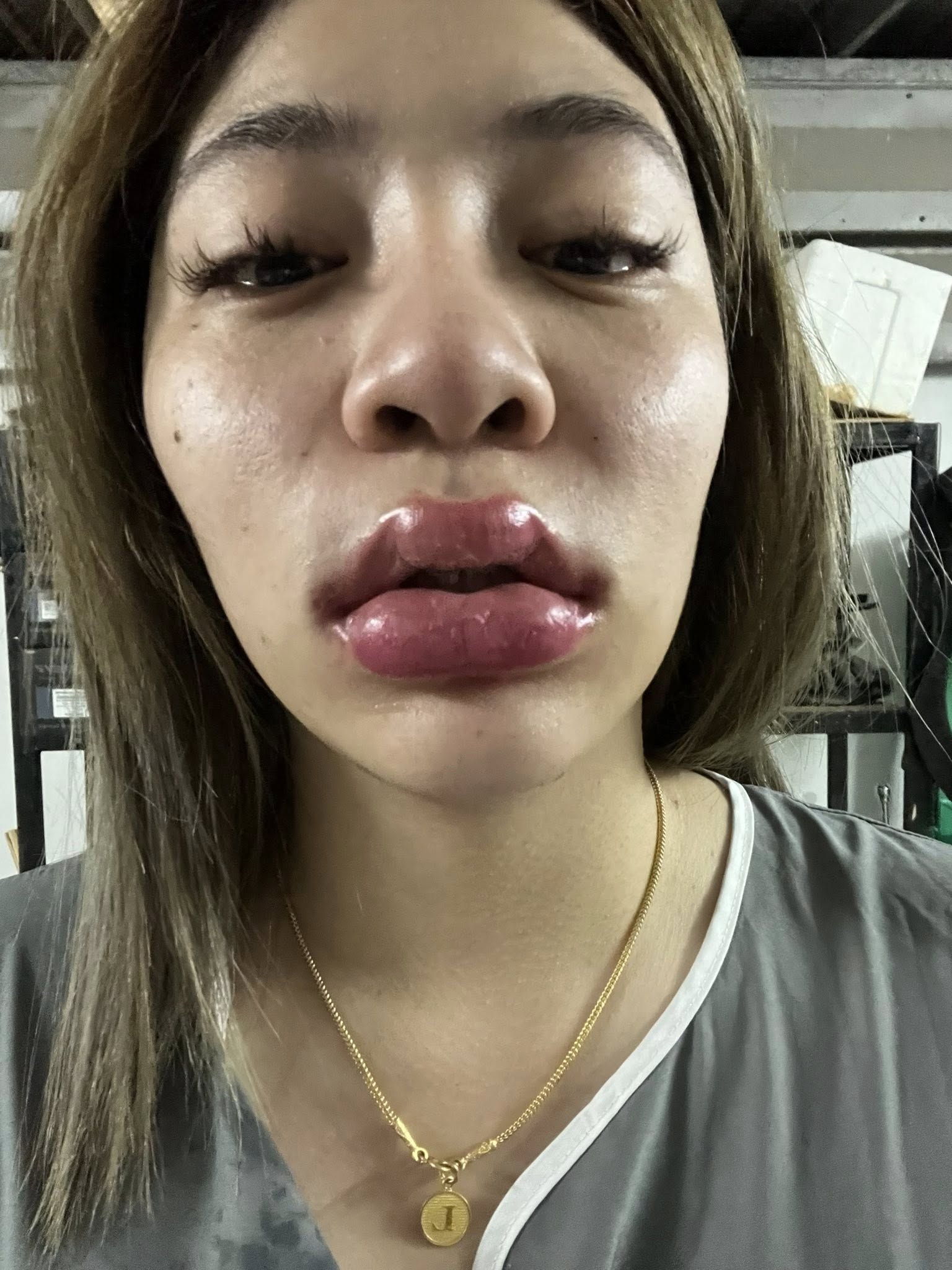 สาวแชร์ประสบการณ์ แพ้ฟิลเลอร์ เสียโฉมจนแพนิค ชาวเน็ตเห็นตรงกัน ไม่ทำก็สวย-3