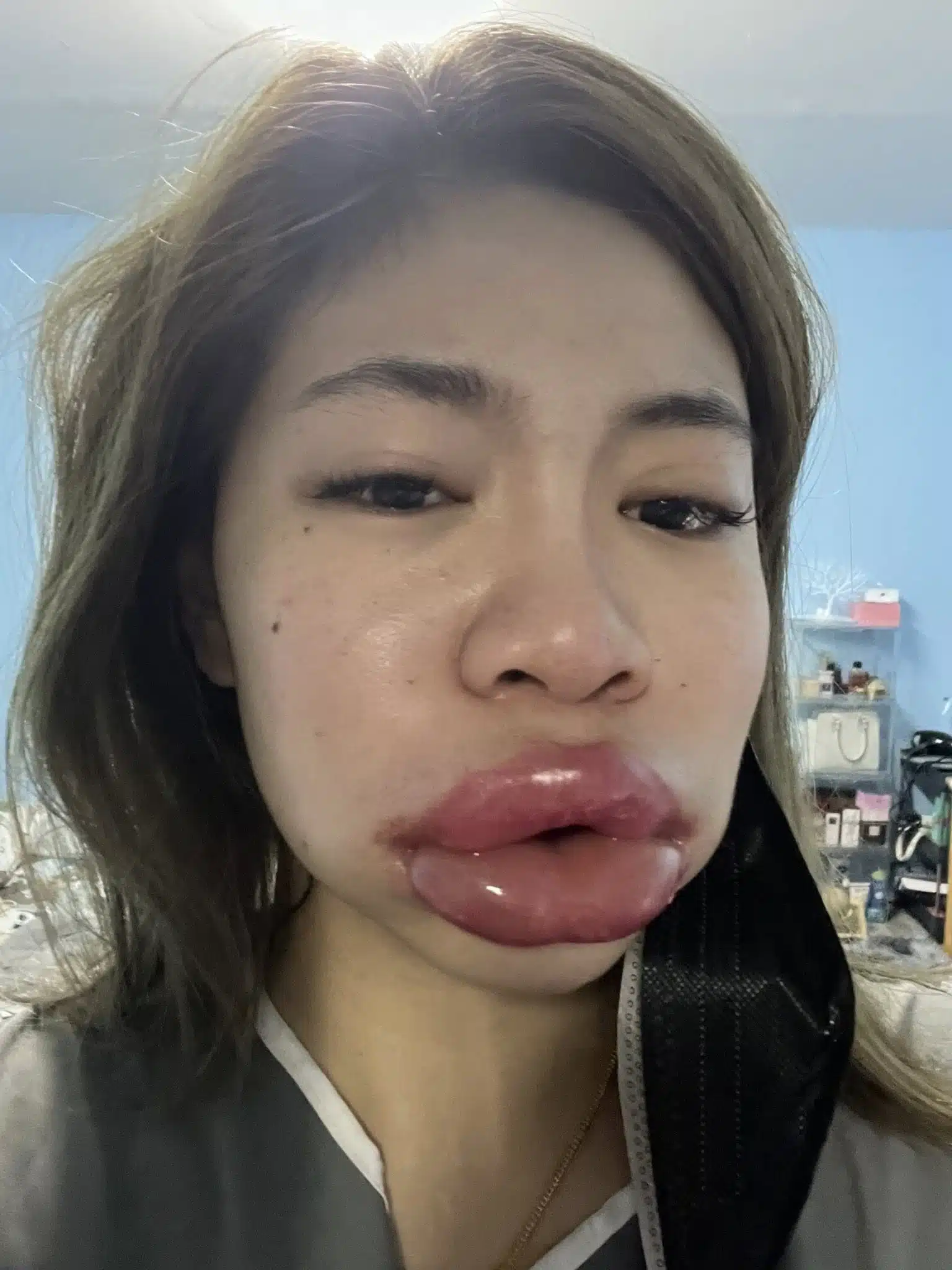 สาวแชร์ประสบการณ์ แพ้ฟิลเลอร์ เสียโฉมจนแพนิค ชาวเน็ตเห็นตรงกัน ไม่ทำก็สวย-5