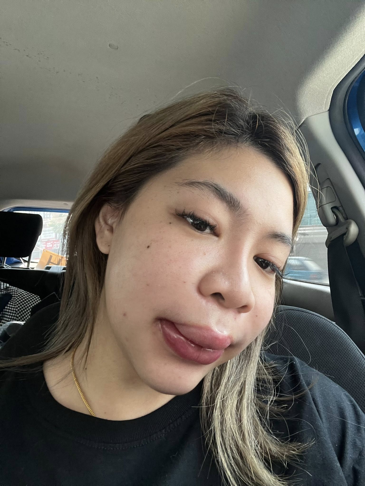 สาวแชร์ประสบการณ์ แพ้ฟิลเลอร์ เสียโฉมจนแพนิค ชาวเน็ตเห็นตรงกัน ไม่ทำก็สวย-6