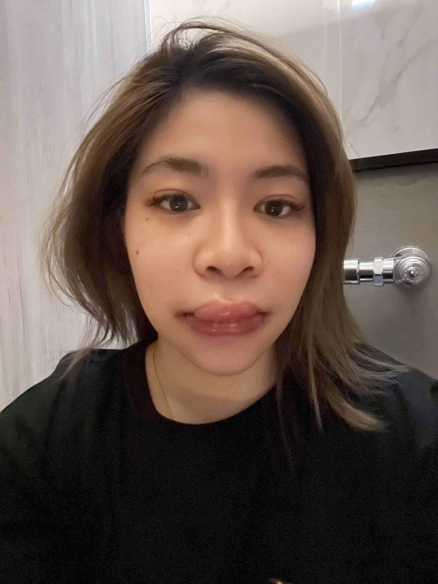 สาวแชร์ประสบการณ์ แพ้ฟิลเลอร์ เสียโฉมจนแพนิค ชาวเน็ตเห็นตรงกัน ไม่ทำก็สวย-7