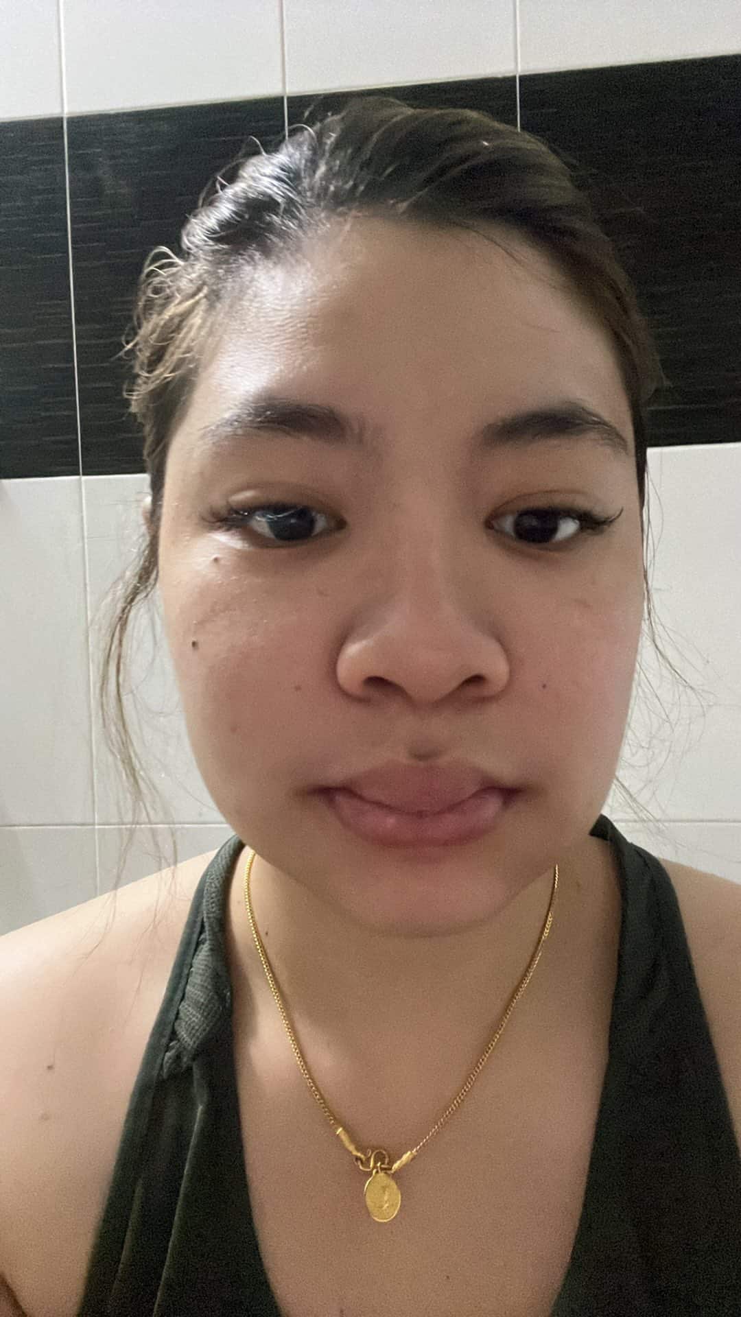 สาวแชร์ประสบการณ์ แพ้ฟิลเลอร์ เสียโฉมจนแพนิค ชาวเน็ตเห็นตรงกัน ไม่ทำก็สวย-8