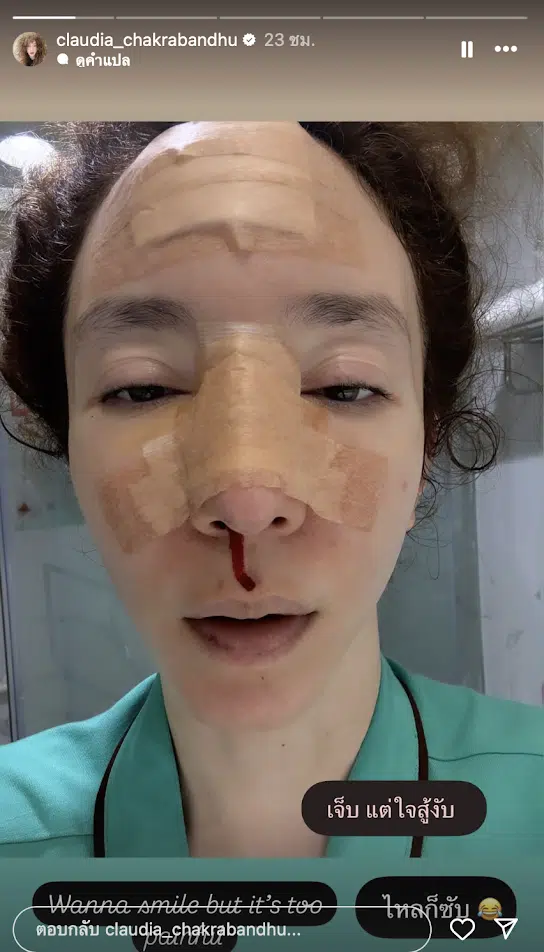 คลาวเดีย เปิดภาพใบหน้า หลังล้มฟาดฟื้น ต้องคอยซับเลือดไหล