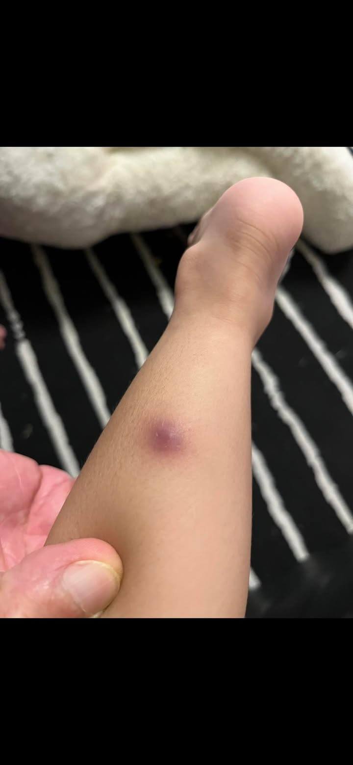 แม่เตือนอันตราย วัณโรคเทียม ทำลูก 2 ขวบ ถูกตัดเนื้อทิ้ง โรคร้ายที่หลายคนไม่รู้จัก-1