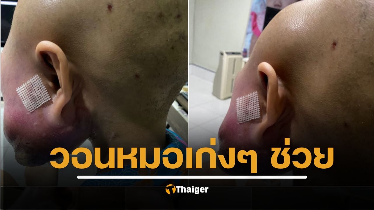 เด็กหญิงวัย 16 ป่วยมะเร็งกระดูกใบหน้ารุนแรง ครอบครัววอน แพทย์-นักวิจัยช่วยรักษา หลังรอเปลี่ยนยาแต่ยังไร้ทางออก