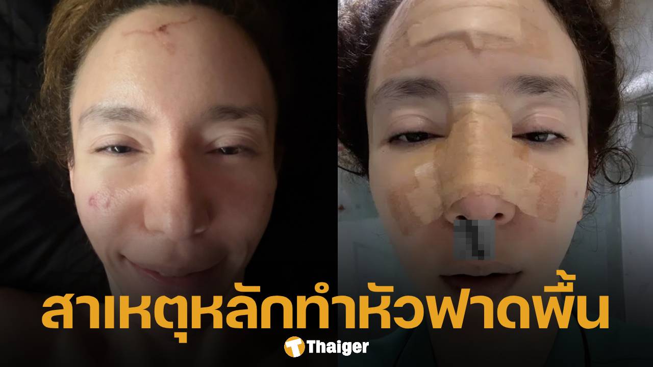 "คลาวเดีย" เปิดใจครั้งแรก สาเหตุทำวูบล้มหัวฟาดพื้น-จมูกหัก เย็บกว่า 40 เข็ม