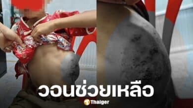 สลดใจ ด.ช. 8 ขวบ ชนโต๊ะไม่กล้าบอกครู ทนเจ็บจนซี่โครงบวมเป่ง เหตุไม่เงินค่ารักษา