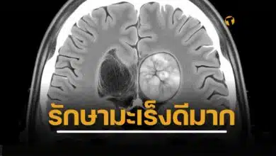 ความหวังใหม่ รักษามะเร็งสมองชนิดรุนแรง ด้วยเซลล์บำบัด ยุบไม่กี่วันหลังรับยา