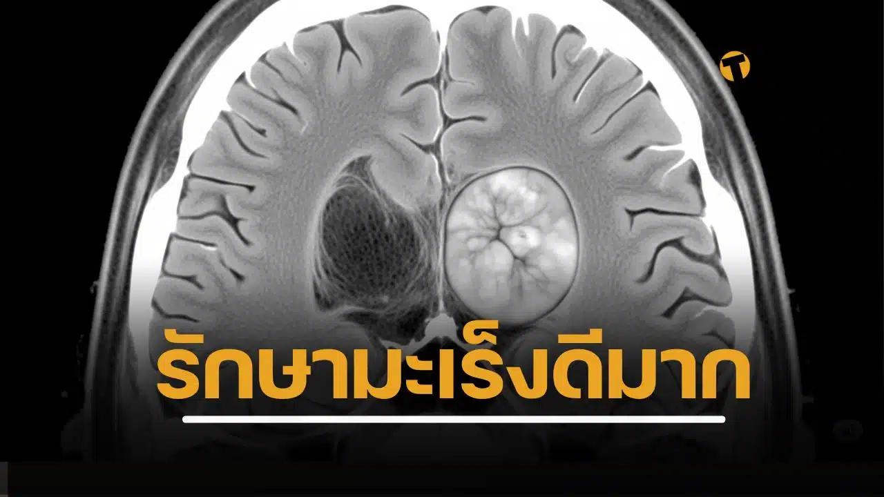 ความหวังใหม่ รักษามะเร็งสมองชนิดรุนแรง ด้วยเซลล์บำบัด ยุบไม่กี่วันหลังรับยา