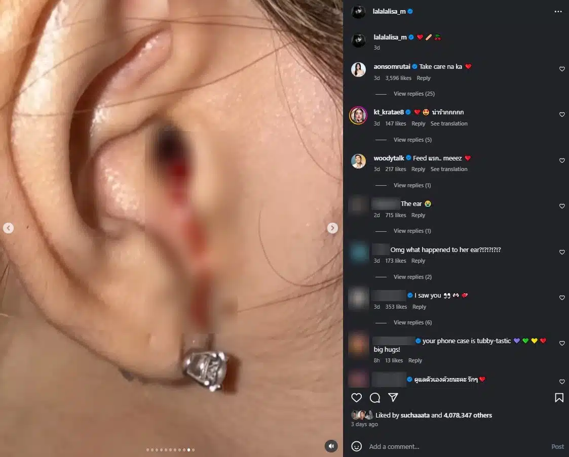 ลิซ่า โพสต์ภาพหูเลือดไหลจากอุบัติเหตุ