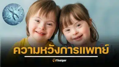 ญี่ปุ่นทำสำเร็จ ใช้เทคโนโลยี CRISPR-Cas9 กำจัดโครโมโซมเกินในเซลล์ดาวน์ซินโดรม ให้กลับมาเป็นปกติ ข่าวใหญ่วงการแพทย์ 