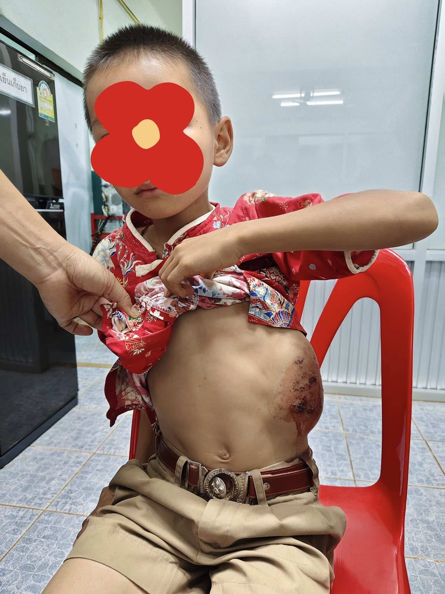 สลดใจ ด.ช. 8 ขวบ ชนโต๊ะไม่กล้าบอกครู ทนเจ็บจนซี่โครงบวมเป่ง เหตุไม่เงินค่ารักษา-2