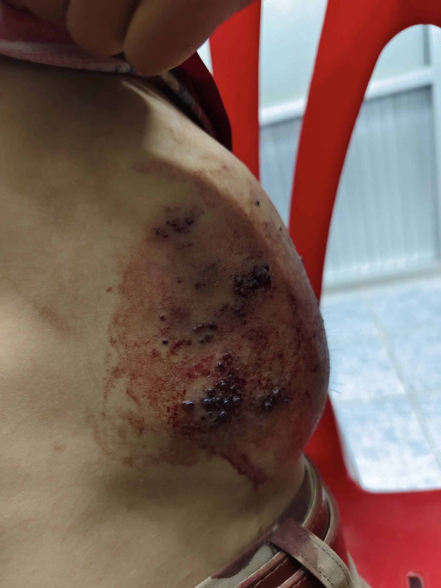 สลดใจ ด.ช. 8 ขวบ ชนโต๊ะไม่กล้าบอกครู ทนเจ็บจนซี่โครงบวมเป่ง เหตุไม่เงินค่ารักษา-3