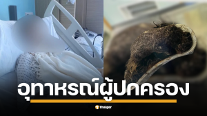 เด็กสาววัย 14 ปี ปวดท้องรุนแรงจนต้องหยุดเรียน แพทย์ตรวจพบก้อนผมขนาดใหญ่เท่าผลเมลอน เตือนกระเพาะอาจขยายใหญ่ผิดปกติไปอีกหลายปี