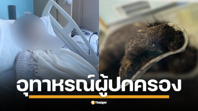 เด็กสาววัย 14 ปี ปวดท้องรุนแรงจนต้องหยุดเรียน แพทย์ตรวจพบก้อนผมขนาดใหญ่เท่าผลเมลอน เตือนกระเพาะอาจขยายใหญ่ผิดปกติไปอีกหลายปี