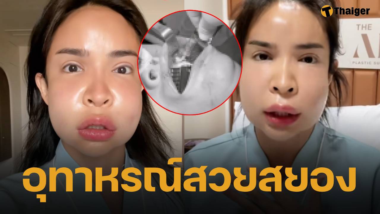นัท นิสามณี แชร์อุทาหรณ์ ฉีดหน้าหมอกระเป๋า สุดท้าย "เน่า" ต้องเข้าผ่าตัดด่วน