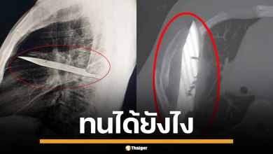 เอกซเรย์หน้าอกของชายวัย 44 ปี ที่แสดงใบมีดขนาดใหญ่ฝังอยู่