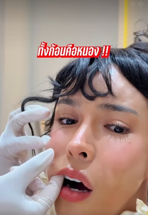 นัท นิสามณี แชร์อุทาหรณ์ ฉีดหน้ากับหมอกระเป๋า สุดท้ายเน่า ต้องเข้าผ่าตัดด่วน-5