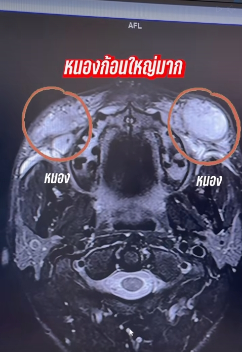 นัท นิสามณี แชร์อุทาหรณ์ ฉีดหน้ากับหมอกระเป๋า สุดท้ายเน่า ต้องเข้าผ่าตัดด่วน-7