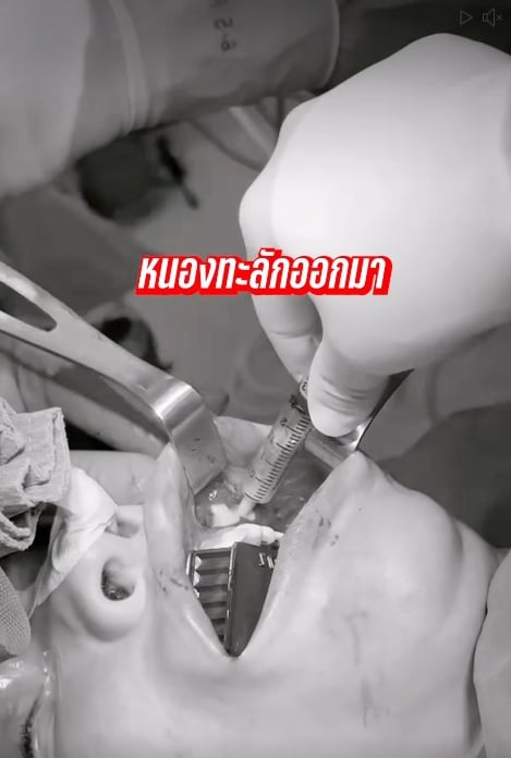 นัท นิสามณี แชร์อุทาหรณ์ ฉีดหน้ากับหมอกระเป๋า สุดท้ายเน่า ต้องเข้าผ่าตัดด่วน-8