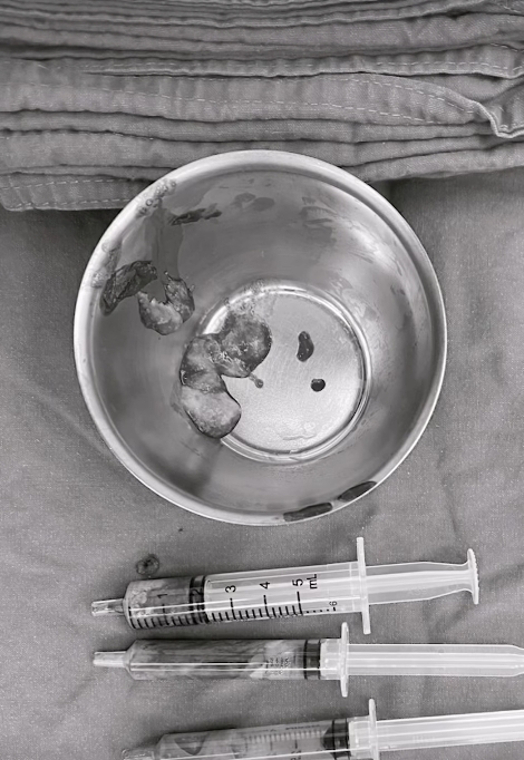 นัท นิสามณี แชร์อุทาหรณ์ ฉีดหน้ากับหมอกระเป๋า สุดท้ายเน่า ต้องเข้าผ่าตัดด่วน-9