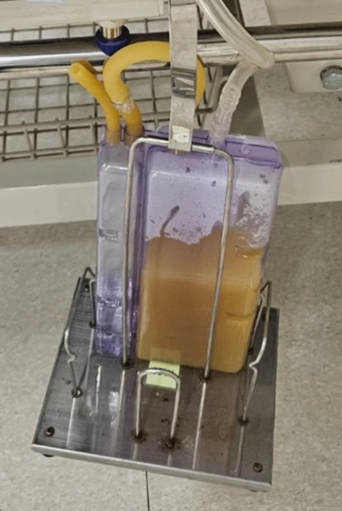 จากการซักประวัติพบว่า ผู้ป่วยรับประทานปูน้ำจืดกับครอบครัวเป็นบางครั้ง