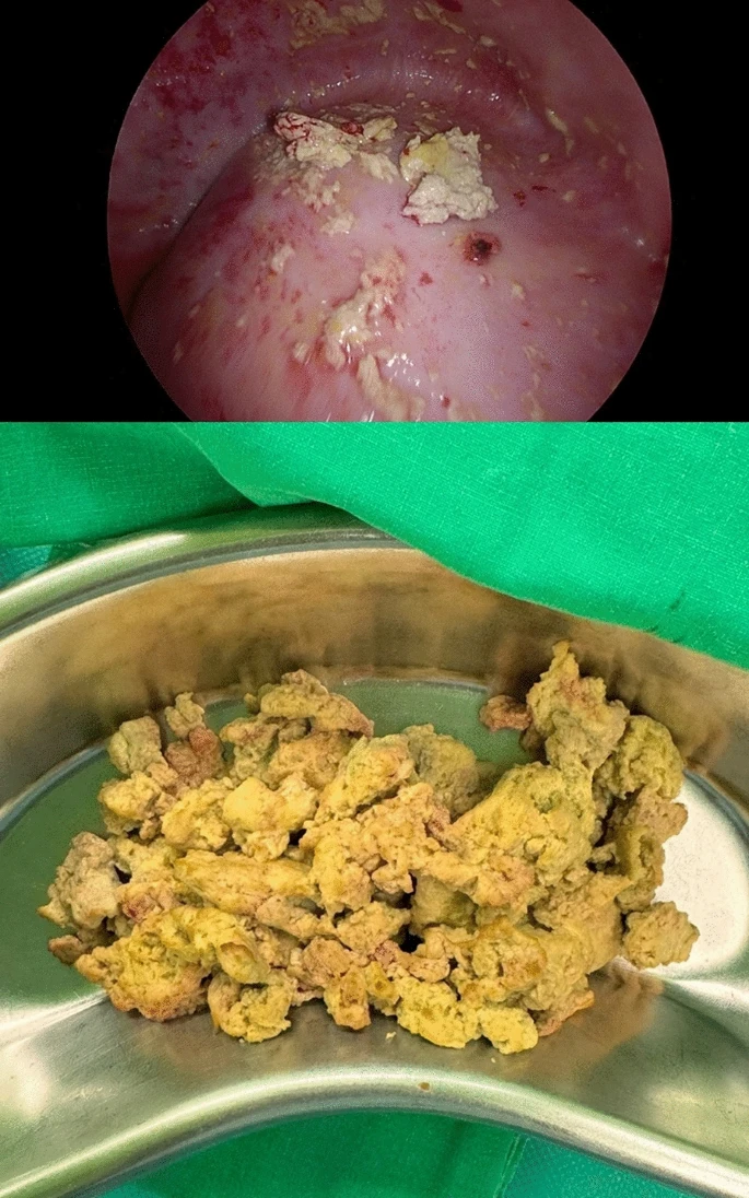 ในเบื้องต้น แพทย์ได้ให้ยาฆ่าพยาธิพราซิควอนเทล (Praziquantel) แก่ผู้ป่วย