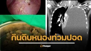 อุทาหรณ์สายของดิบ! เด็กหญิง 14 ปีกินปูดิบ ป่วยหนักปอดแฟบ พบพยาธิใบไม้ปอดทำหนองท่วม