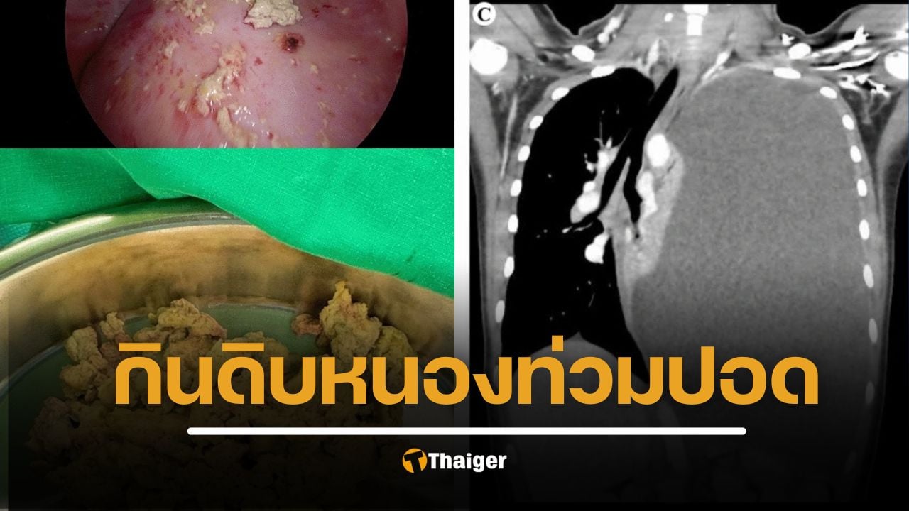 อุทาหรณ์สายของดิบ! เด็กหญิง 14 ปีกินปูดิบ ป่วยหนักปอดแฟบ พบพยาธิใบไม้ปอดทำหนองท่วม