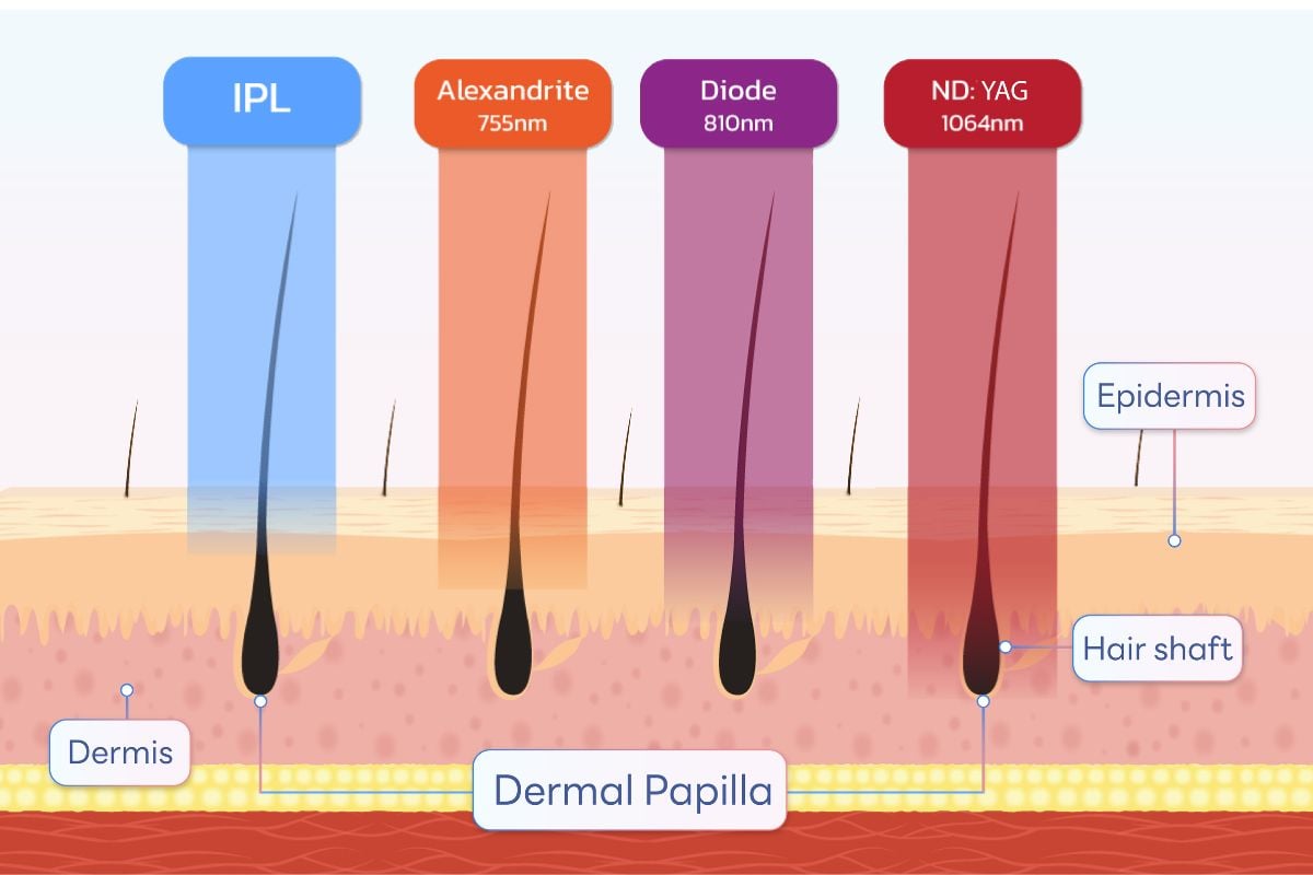 เลเซอร์บราซิลเลี่ยน มีกี่แบบ