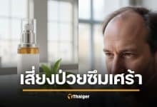 งานวิจัยชี้ "ฟิแนสเทอไรด์" ยารักษาผมร่วงที่คนใช้ทั่วโลก เสี่ยงซึมเศร้า-คิดสั้น