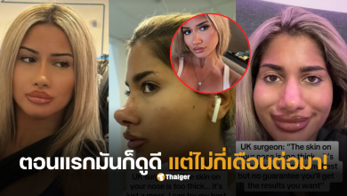 ศัลยกรรมจมูก ไมเคิลแจ็คสัน