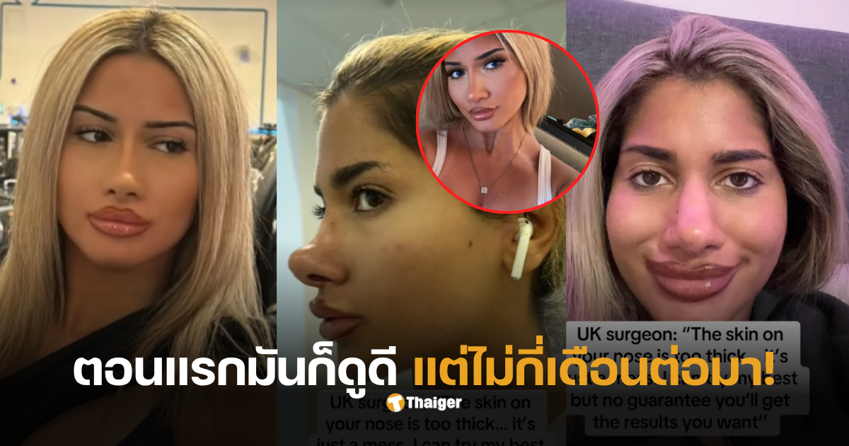 ศัลยกรรมจมูก ไมเคิลแจ็คสัน