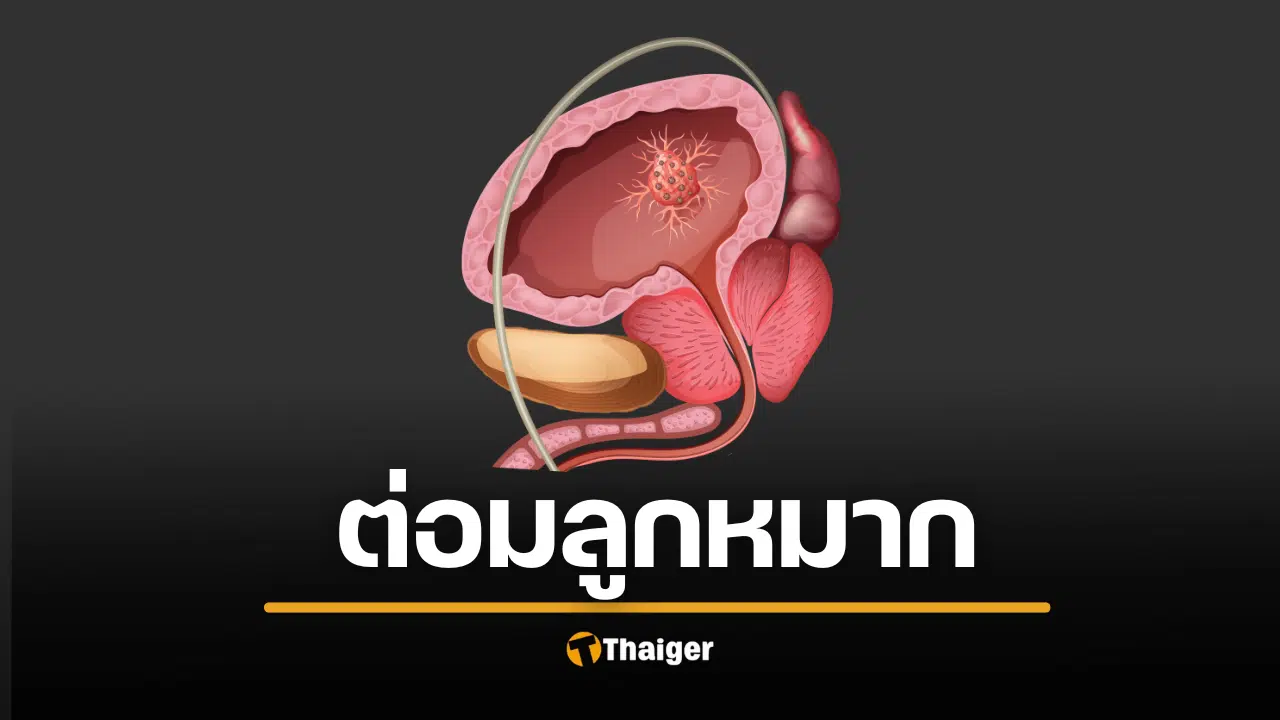 มะเร็งต่อมลูกหมาก มักพบบ่อยในชายสูงอายุ