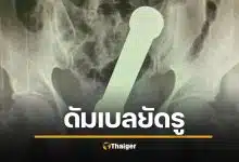 ชายวัย 54 ยัดดัมเบล 2 กก. เข้ารูทวาร แพทย์ตะลึง ต้องช่วยใช้มือล้วงออก