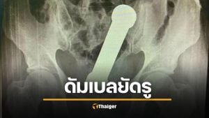 ชายวัย 54 ยัดดัมเบล 2 กก. เข้ารูทวาร แพทย์ตะลึง ต้องช่วยใช้มือล้วงออก