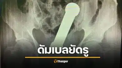 ชายวัย 54 ยัดดัมเบล 2 กก. เข้ารูทวาร แพทย์ตะลึง ต้องช่วยใช้มือล้วงออก