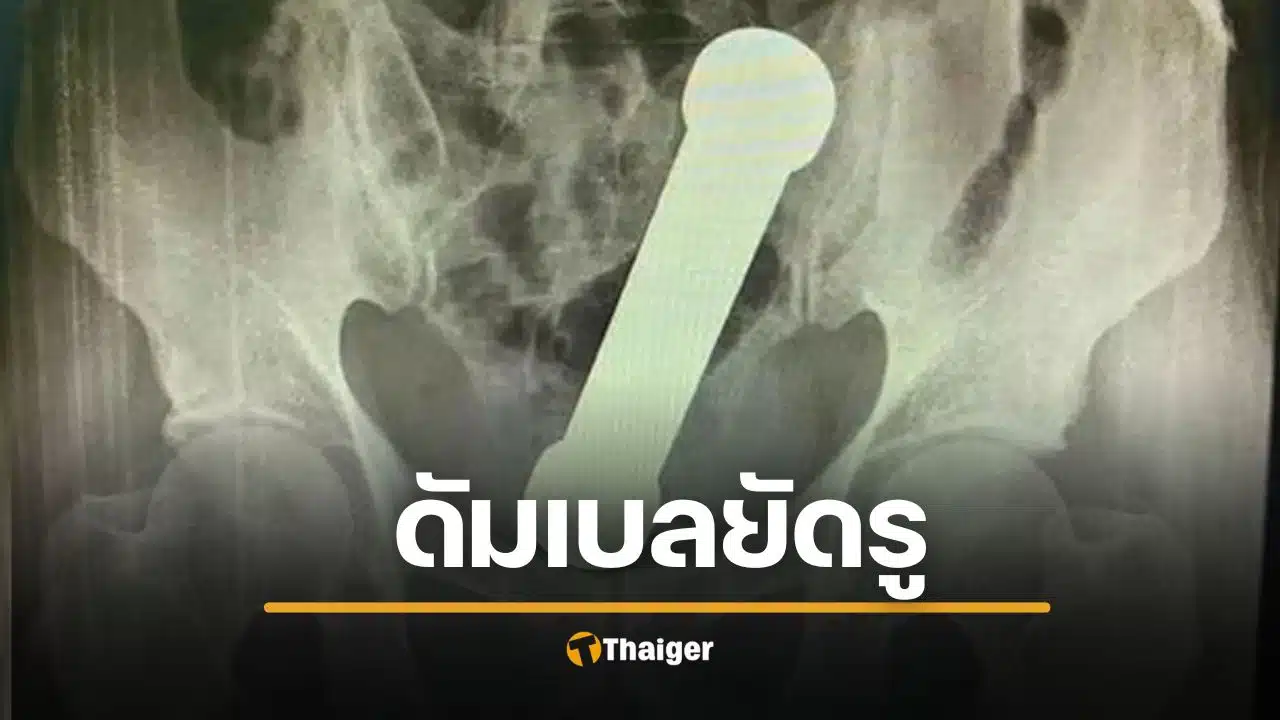 ชายวัย 54 ยัดดัมเบล 2 กก. เข้ารูทวาร แพทย์ตะลึง ต้องช่วยใช้มือล้วงออก